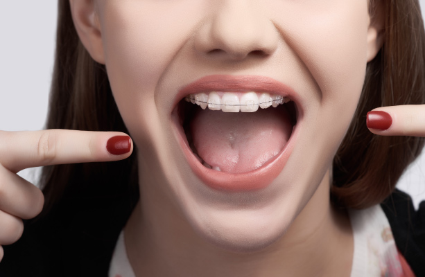 young woman pointing at accelerated braces straightening teeth