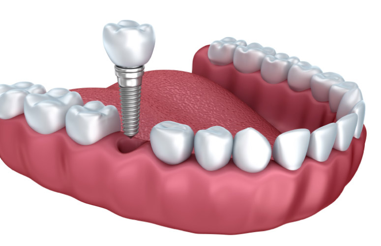 dental implant procedure model