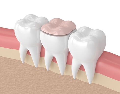 dental implant vs crown