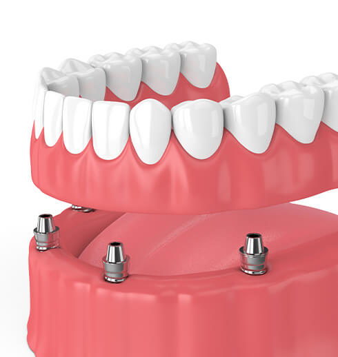 implant supported dentures