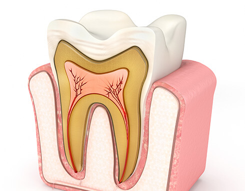 root canal