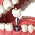 Closeup of a dental implant tooth replacement solution in Canton, GA
