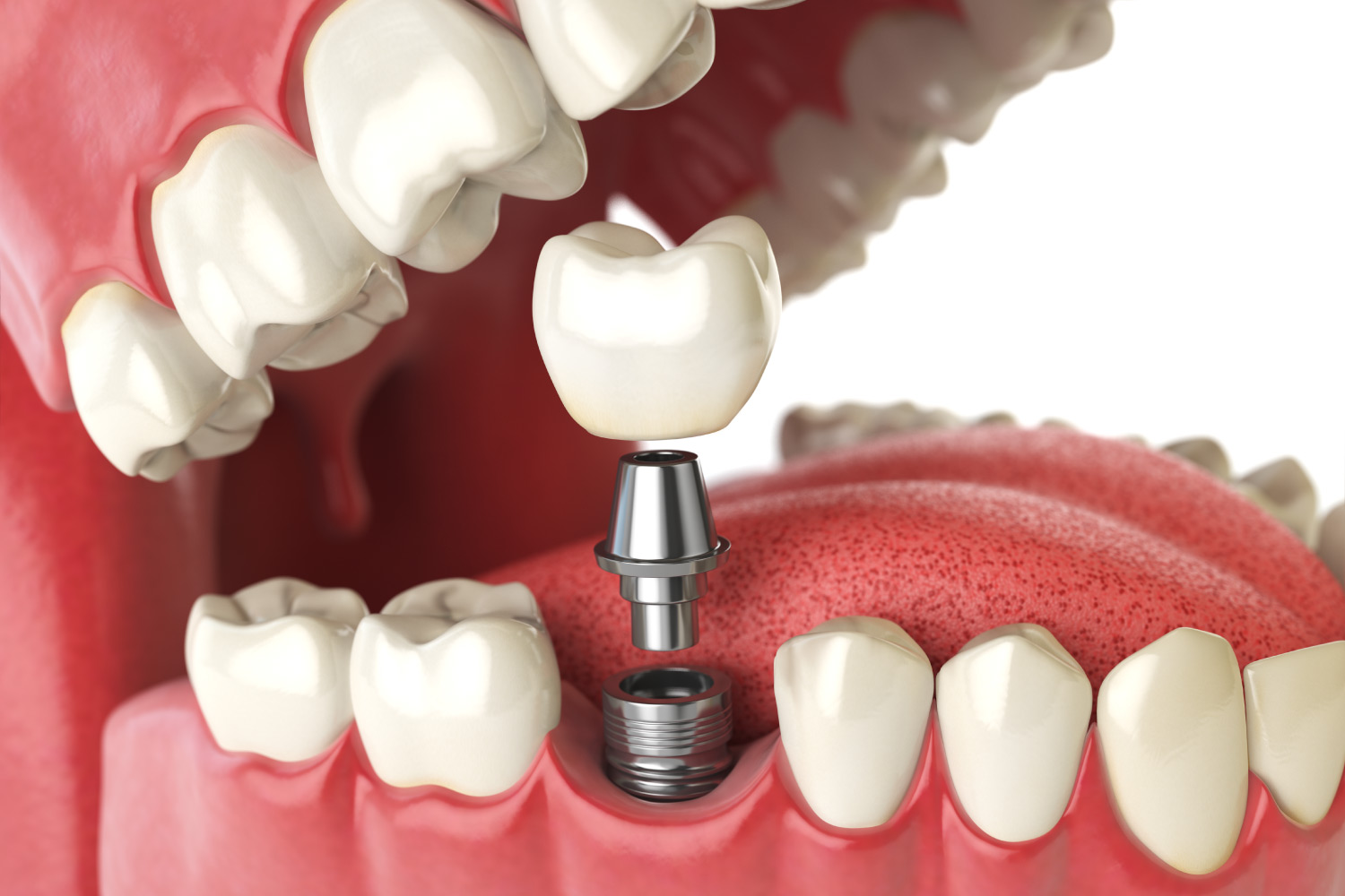 Closeup of a dental implant tooth replacement solution in Canton, GA