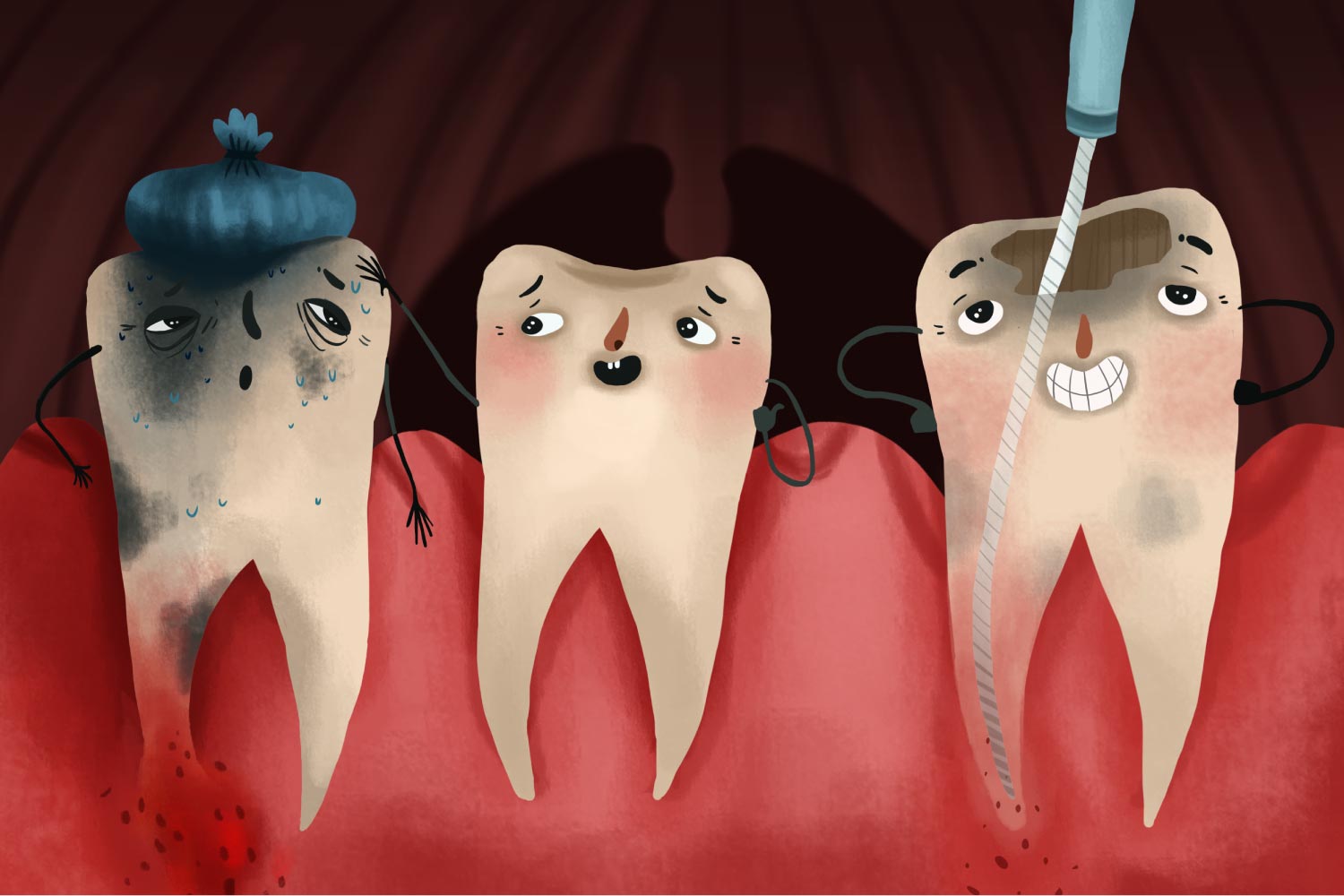 Cartoon showing tooth decay in different stages with one tooth getting root canal therapy