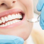 Closeup of a woman's teeth after receiving teeth bonding in Canton, GA to correct a chip