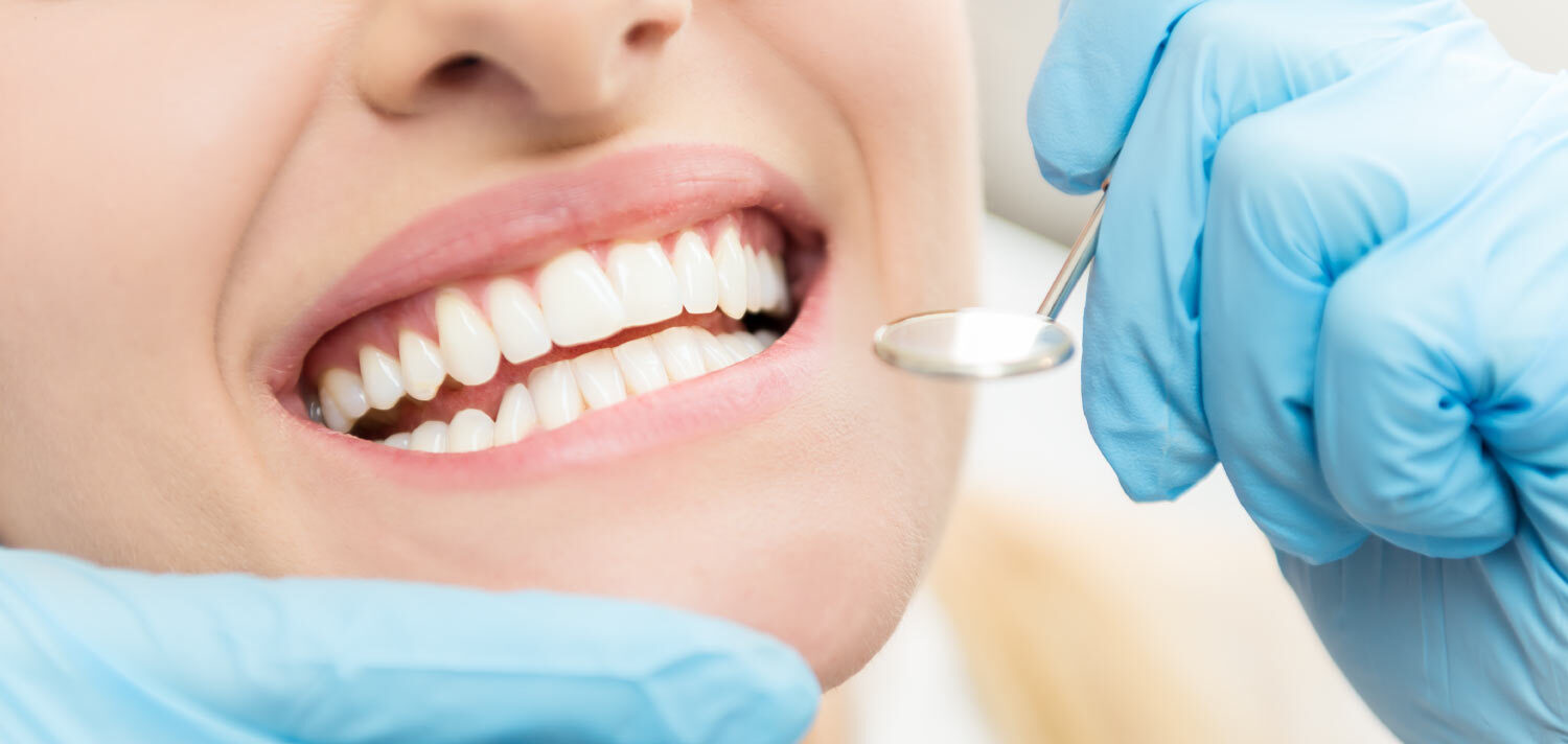 Closeup of a woman's teeth after receiving teeth bonding in Canton, GA to correct a chip