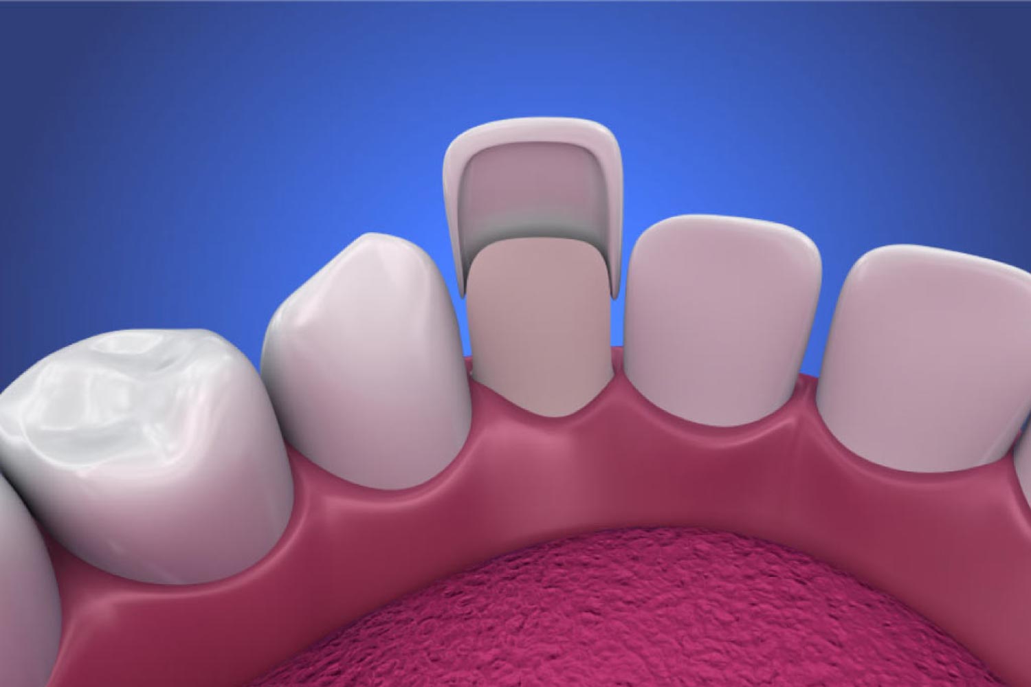 dental veneer illustration