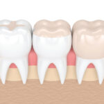 illustration of dental fillings