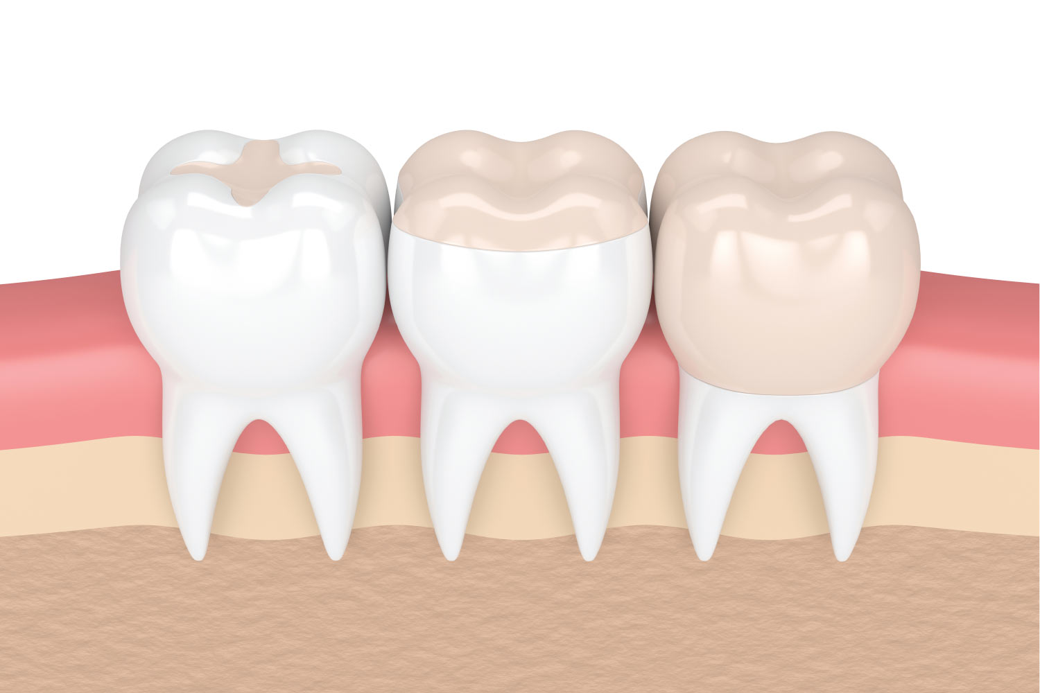 illustration of dental fillings