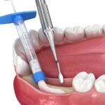 bone graft procedure on mandible to restore bone for a dental implant or restoration