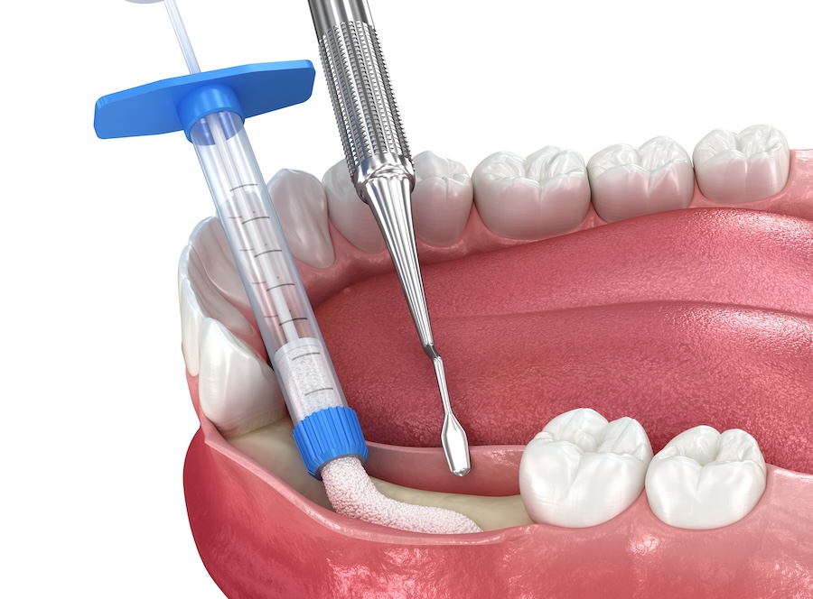 bone graft procedure on mandible to restore bone for a dental implant or restoration