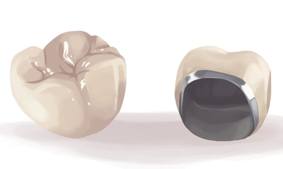 porcelain fused to metal (PFM) crown for implant crown restoration