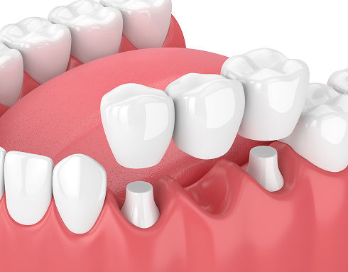 illustration of dental bridge